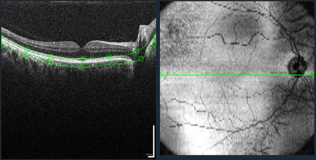 Bscan and en face projection in oculink